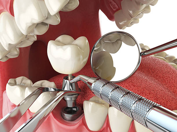 Best Emergency Dental Extractions in Alto, TX